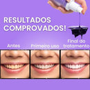 Clareador Dental iziSmile - Dentes Brancos Em Segundos [Desconto + Entrega Gratis Hoje]